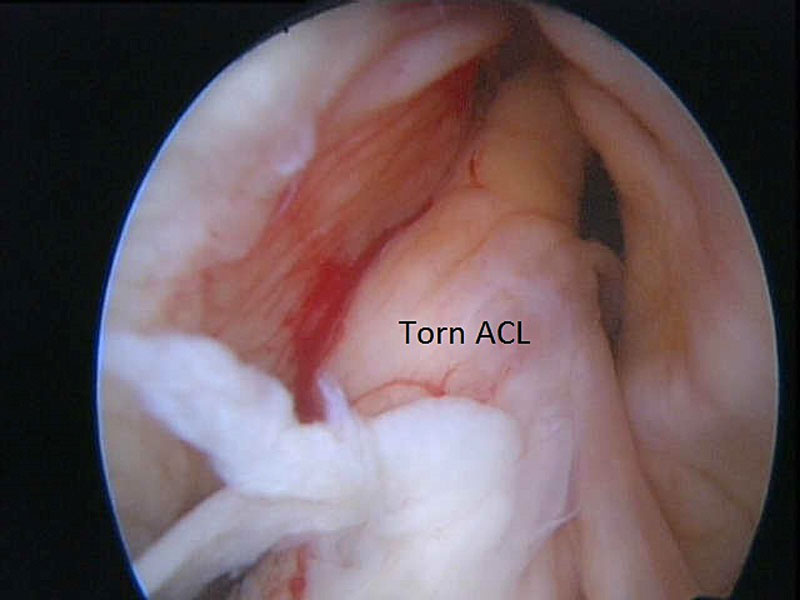 image of Torn ACL at arthroscopy. knee sports injuries consultant Mr Aslam Mohammed 25 years experience in treating meniscal tears in high level atheltics   knee injuries